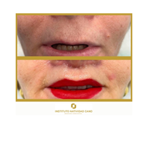 Dra. Natividad Cano técnica lip lift