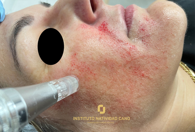 microneedling que es y para que sirve